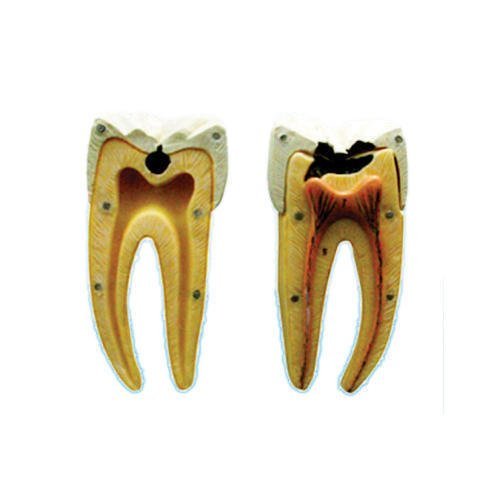 Dental-Caries-Model.jpg Dental Caries Model